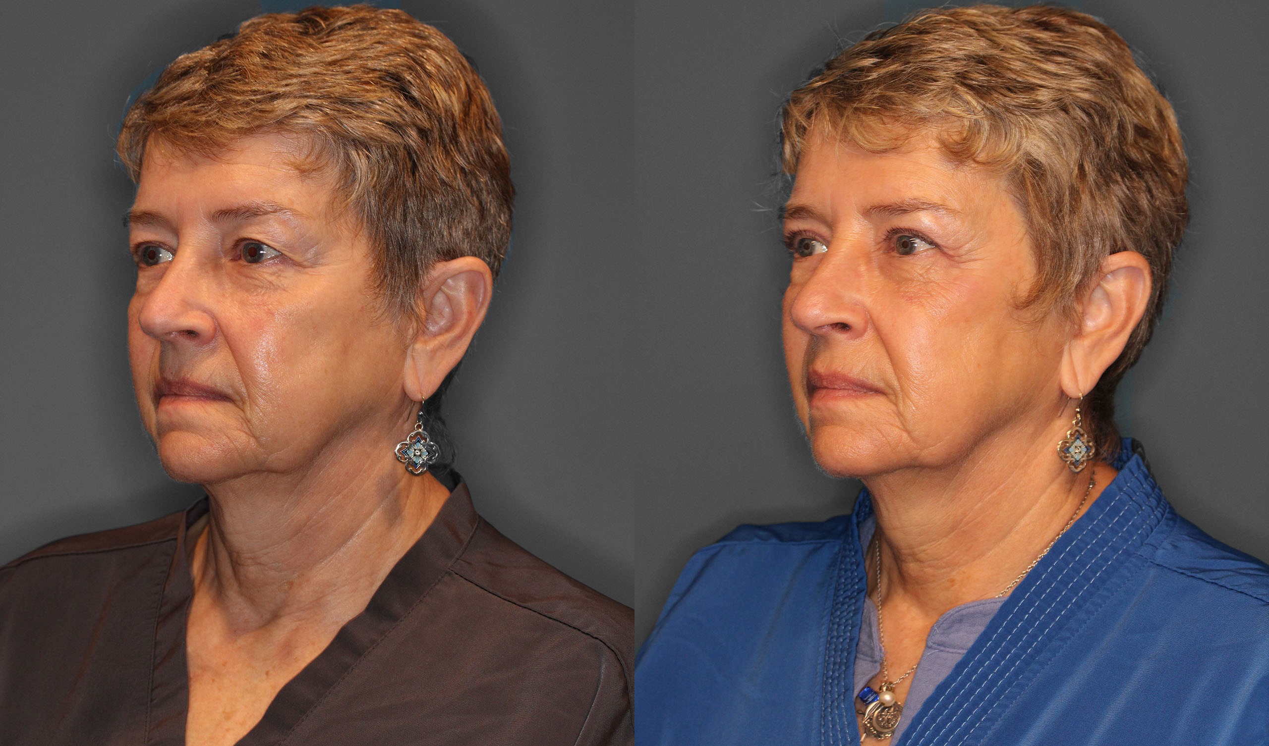 Upper Eyelid Lift Before and After photo by Dr. Abigail Rodriguez in Houston, TX