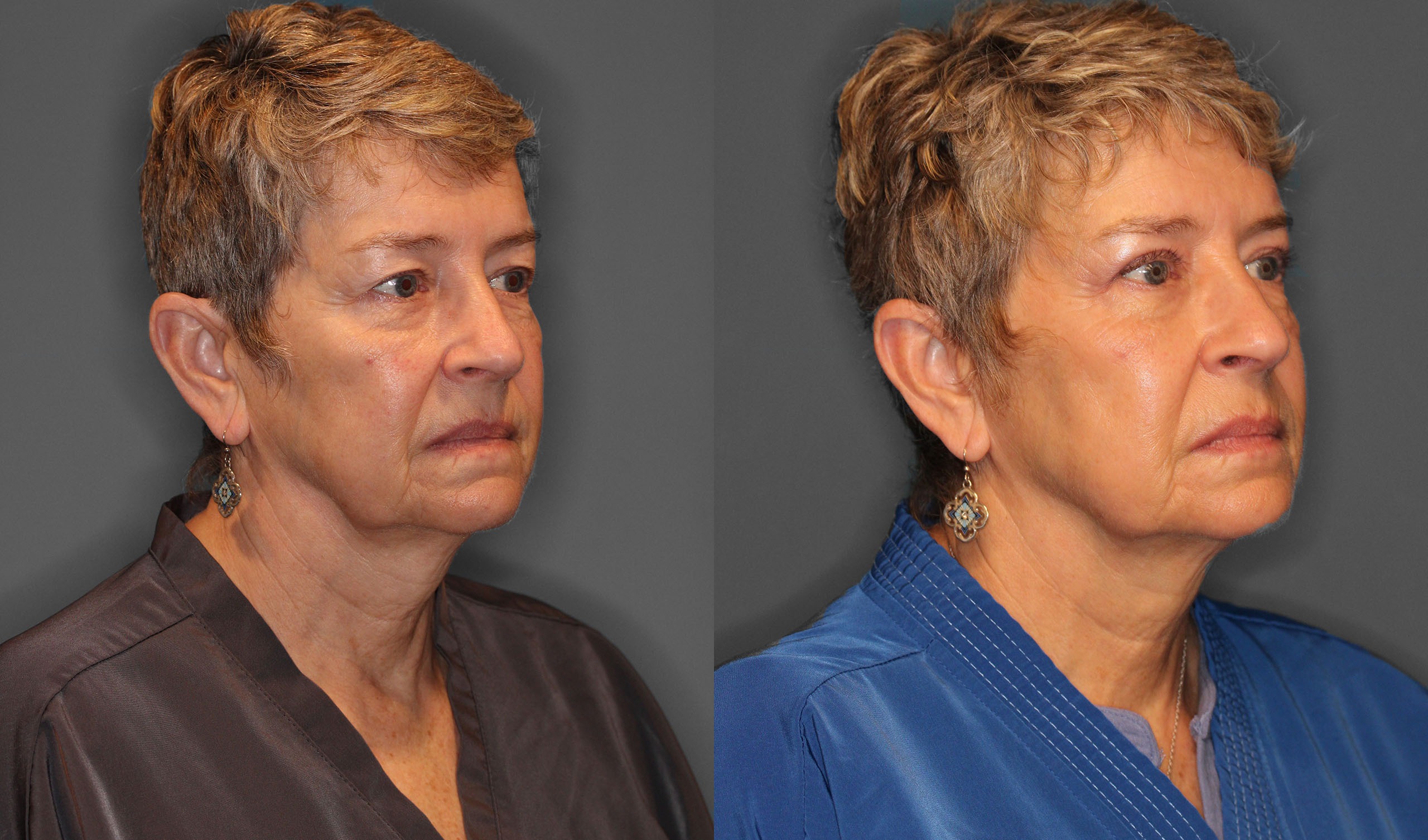 Upper Eyelid Lift Before and After photo by Dr. Abigail Rodriguez in Houston, TX
