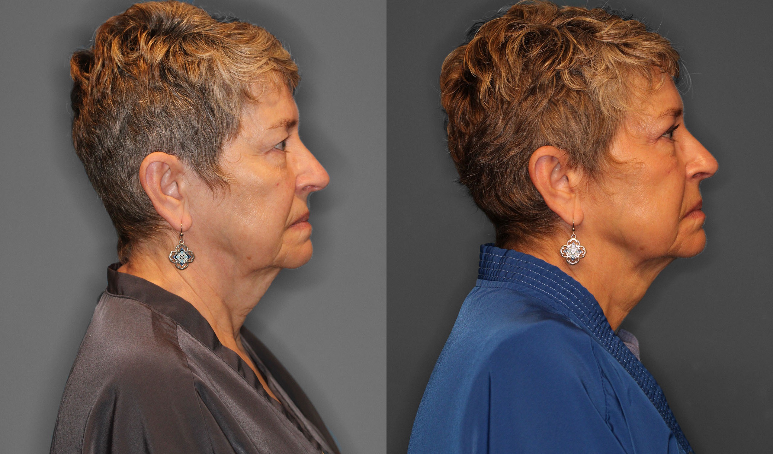Upper Eyelid Lift Before and After photo by Dr. Abigail Rodriguez in Houston, TX