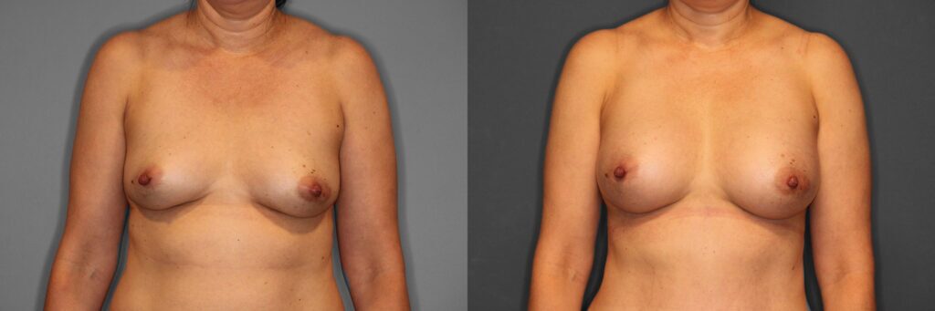 Breast Augmentation Before and After photo by Dr. Abigail Rodriguez in Houston, TX