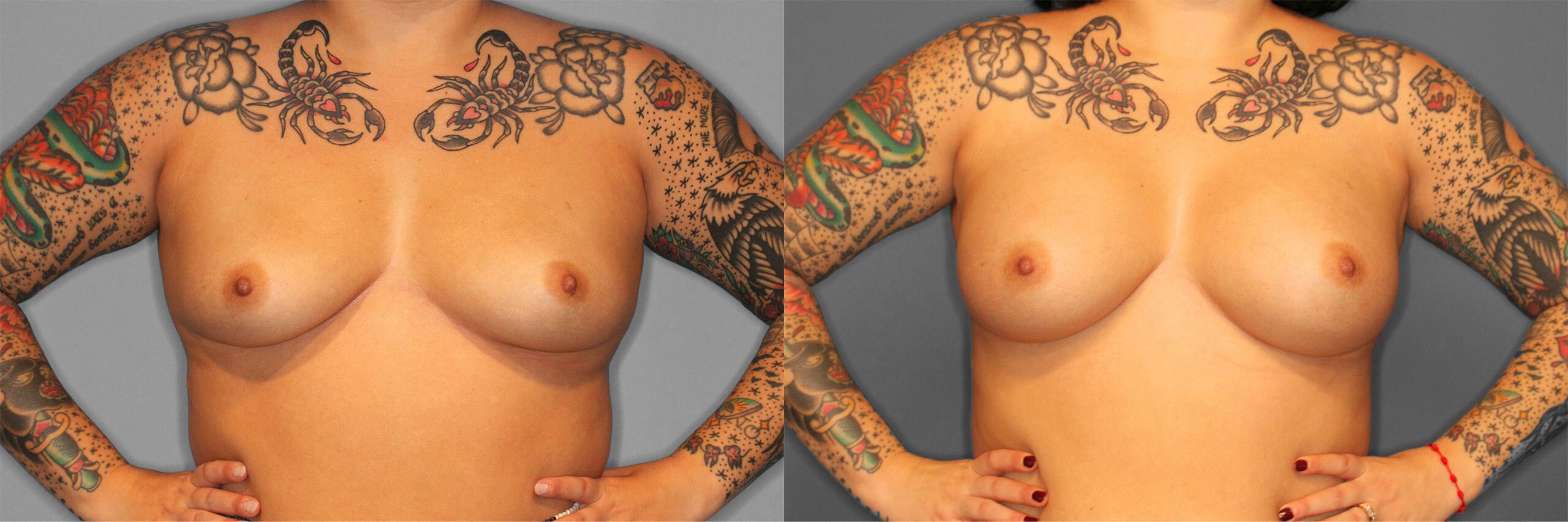 Breast Augmentation Before and After photo by Dr. Abigail Rodriguez in Houston, TX