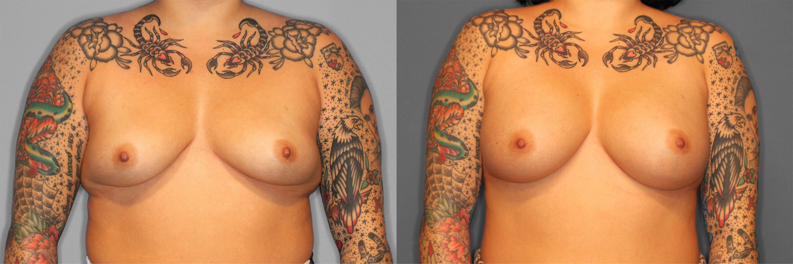 Breast Augmentation Before and After photo by Dr. Abigail Rodriguez in Houston, TX