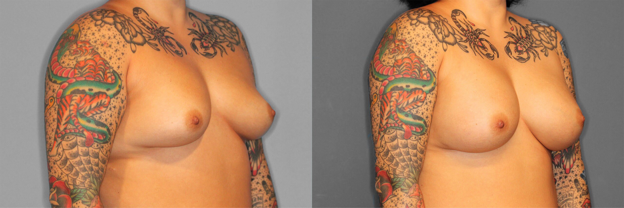 Breast Augmentation Before and After photo by Dr. Abigail Rodriguez in Houston, TX