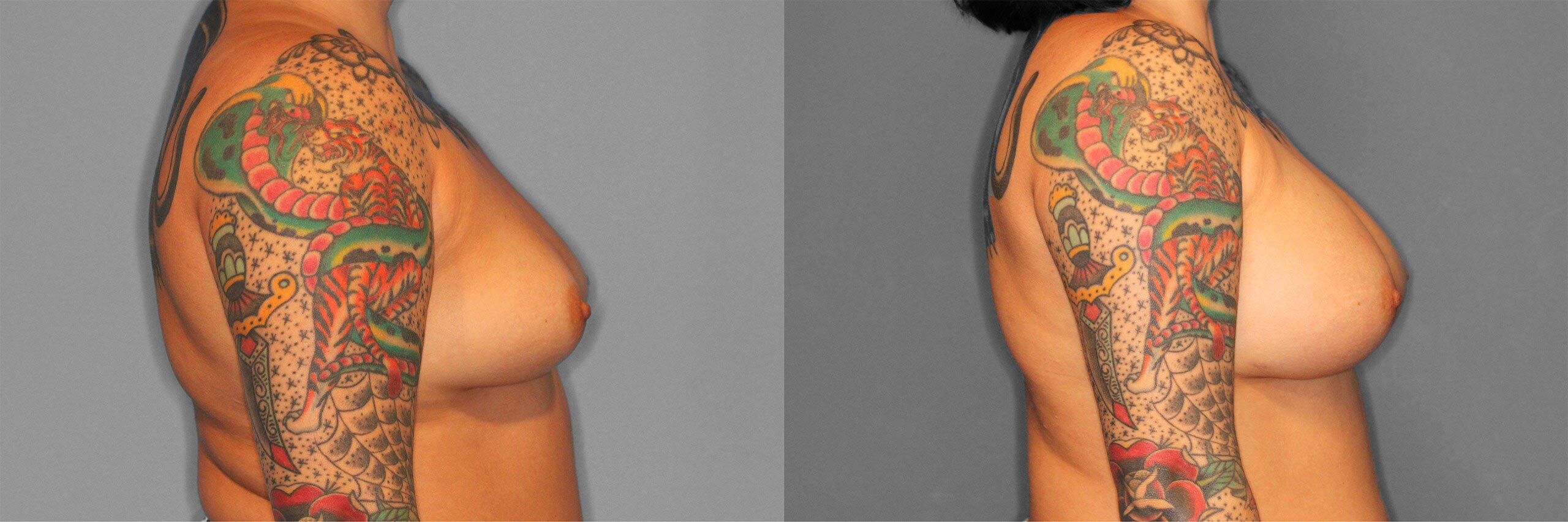 Breast Augmentation Before and After photo by Dr. Abigail Rodriguez in Houston, TX