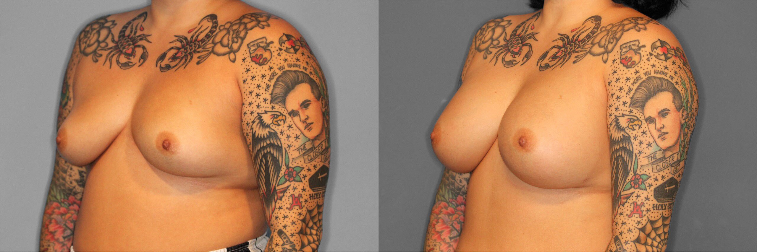 Breast Augmentation Before and After photo by Dr. Abigail Rodriguez in Houston, TX