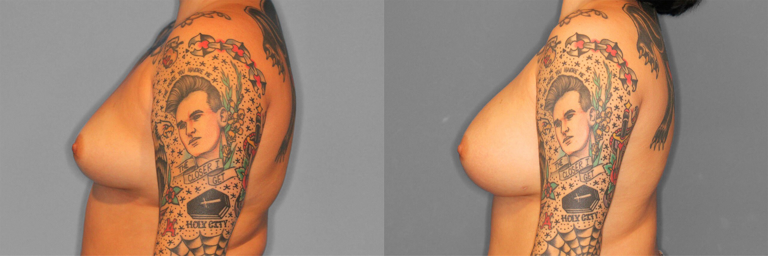 Breast Augmentation Before and After photo by Dr. Abigail Rodriguez in Houston, TX