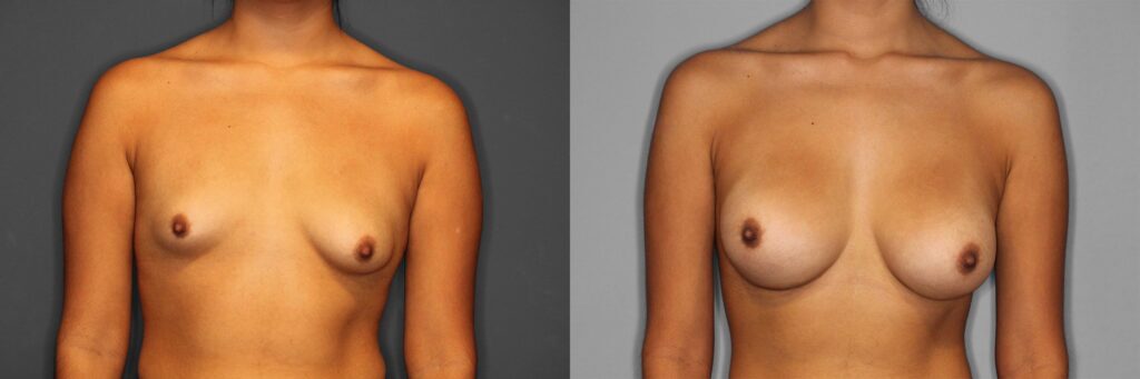 Breast Augmentation Before and After photo by Dr. Abigail Rodriguez in Houston, TX