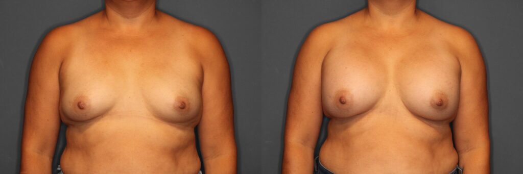 Breast Augmentation Before and After photo by Dr. Abigail Rodriguez in Houston, TX