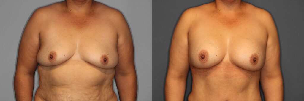 Breast Augmentation Before and After photo by Dr. Abigail Rodriguez in Houston, TX