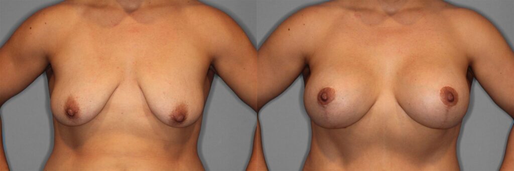 Breast Augmentation with Lift Before and After photo by Dr. Abigail Rodriguez in Houston, TX