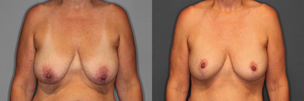 Breast Augmentation with Lift Before and After photo by Dr. Abigail Rodriguez in Houston, TX