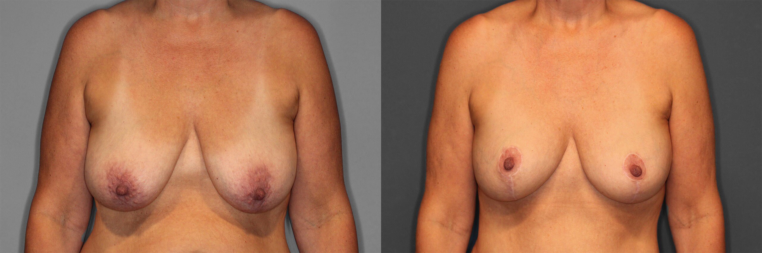 Breast Augmentation with Lift Before and After photo by Dr. Abigail Rodriguez in Houston, TX