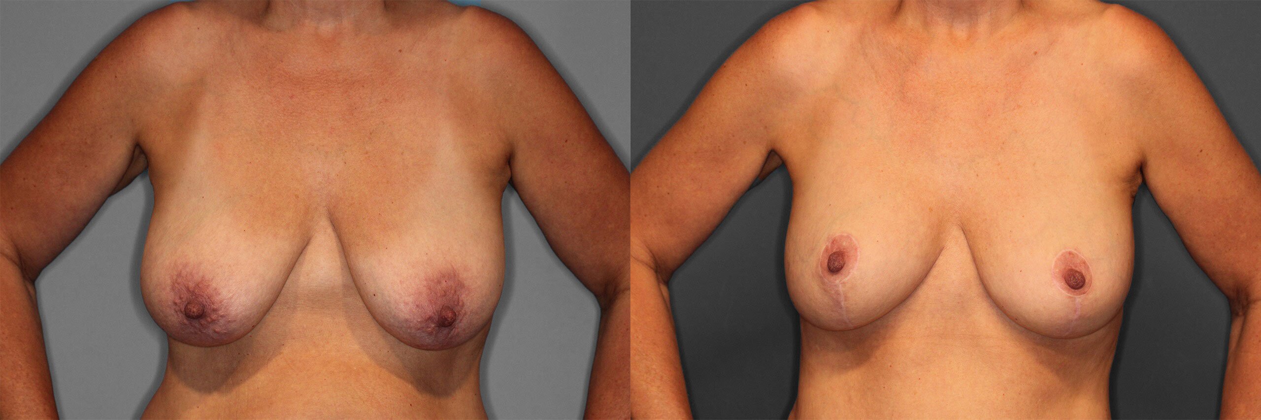 Breast Augmentation with Lift Before and After photo by Dr. Abigail Rodriguez in Houston, TX