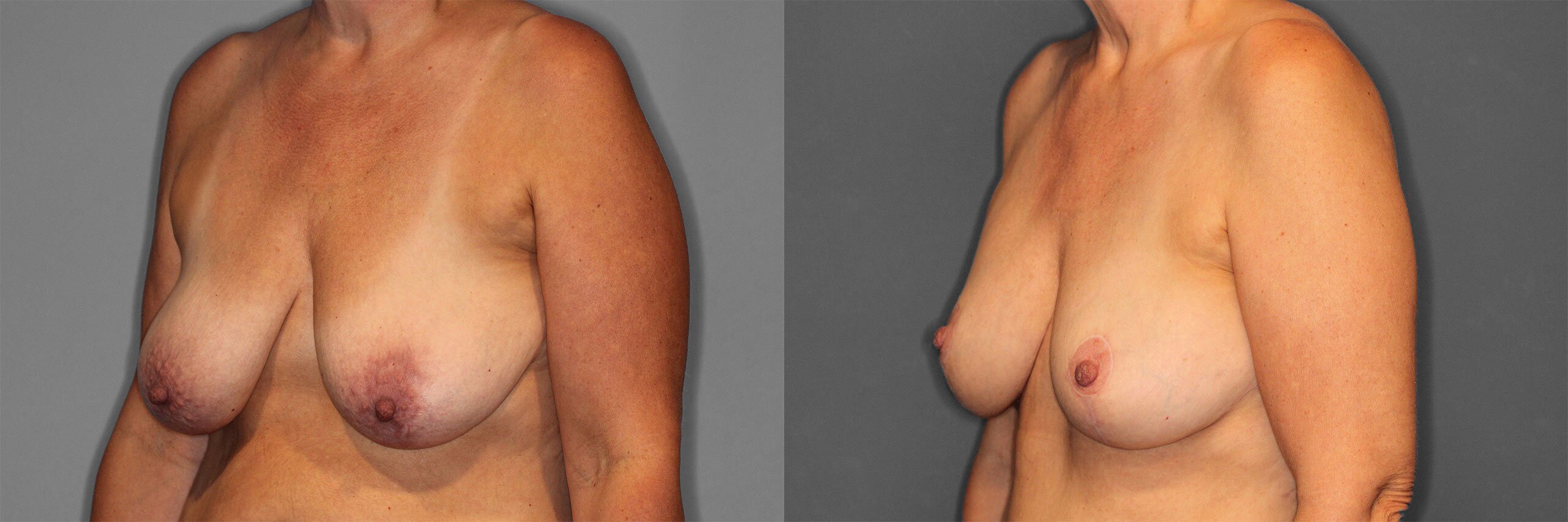 Breast Augmentation with Lift Before and After photo by Dr. Abigail Rodriguez in Houston, TX
