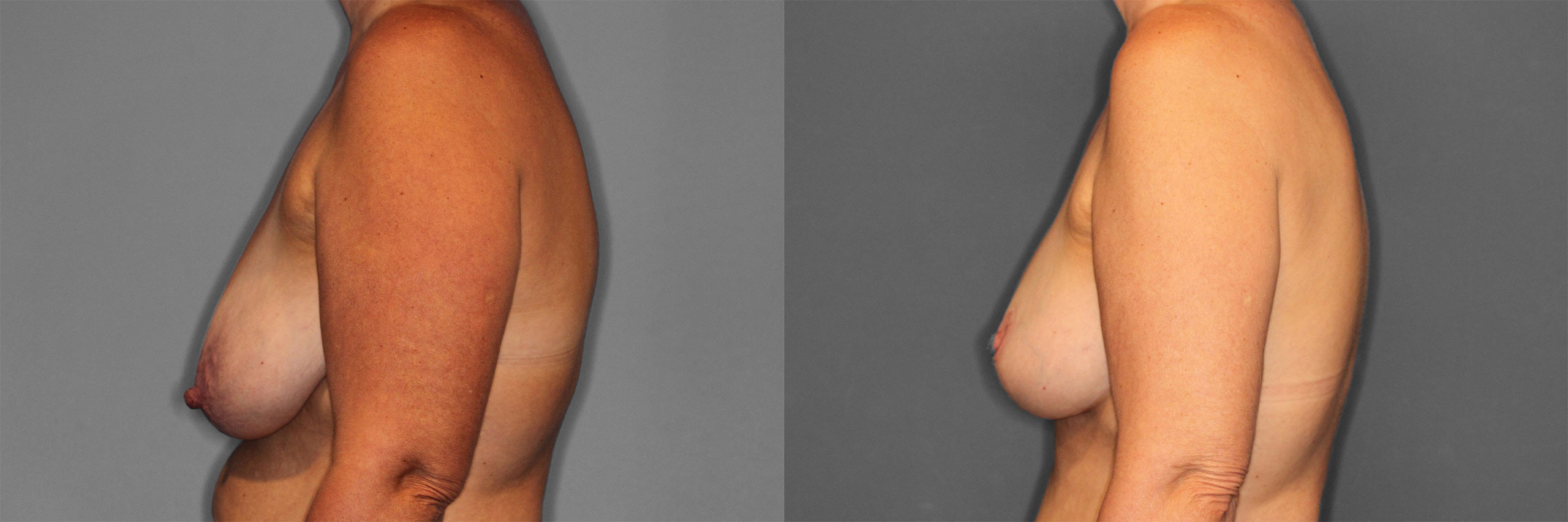 Breast Augmentation with Lift Before and After photo by Dr. Abigail Rodriguez in Houston, TX