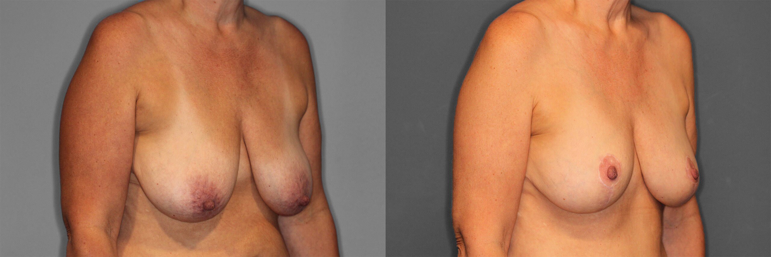 Breast Augmentation with Lift Before and After photo by Dr. Abigail Rodriguez in Houston, TX