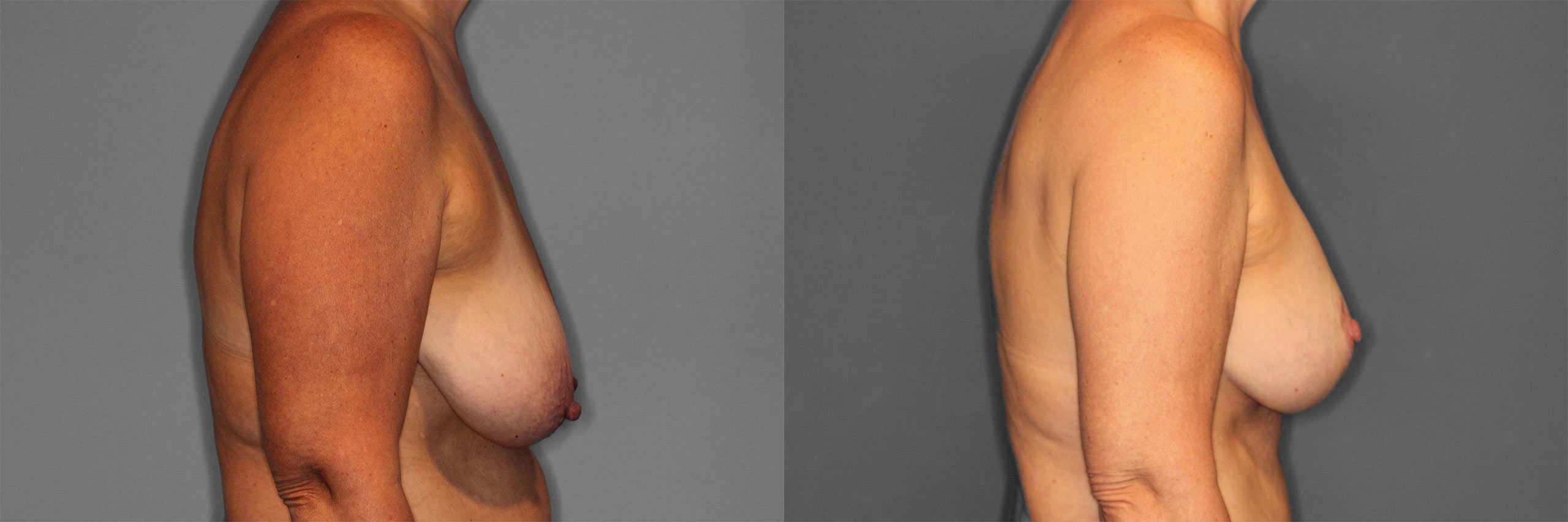 Breast Augmentation with Lift Before and After photo by Dr. Abigail Rodriguez in Houston, TX