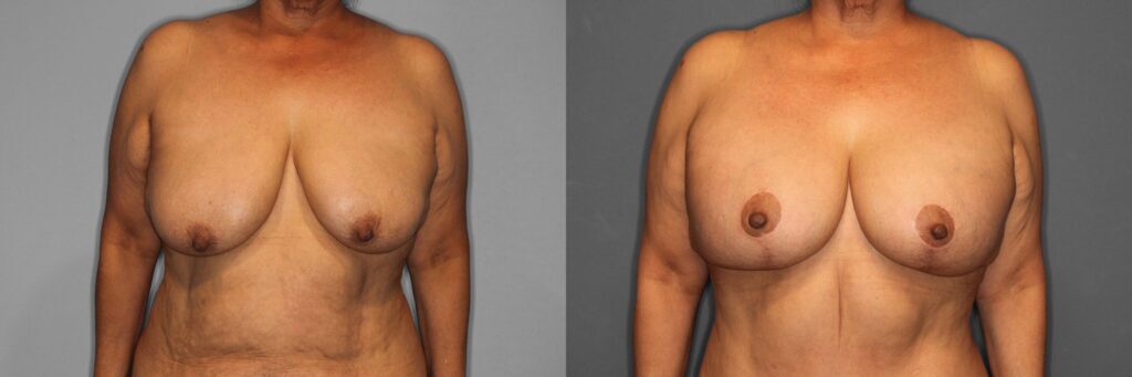 Breast Augmentation with Lift Before and After photo by Dr. Abigail Rodriguez in Houston, TX
