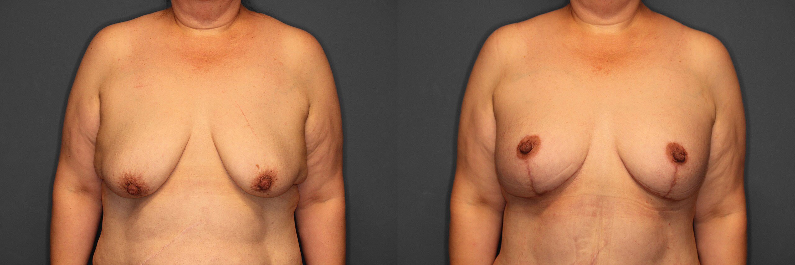 Breast Augmentation with Lift Before and After photo by Dr. Abigail Rodriguez in Houston, TX