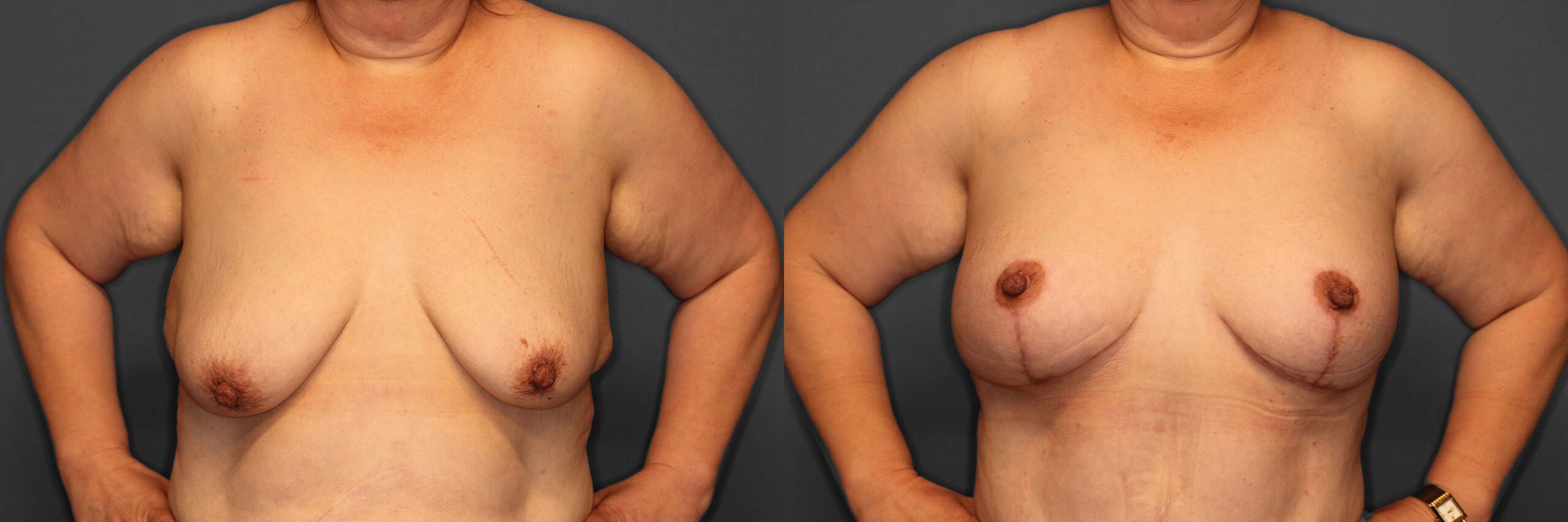 Breast Augmentation with Lift Before and After photo by Dr. Abigail Rodriguez in Houston, TX