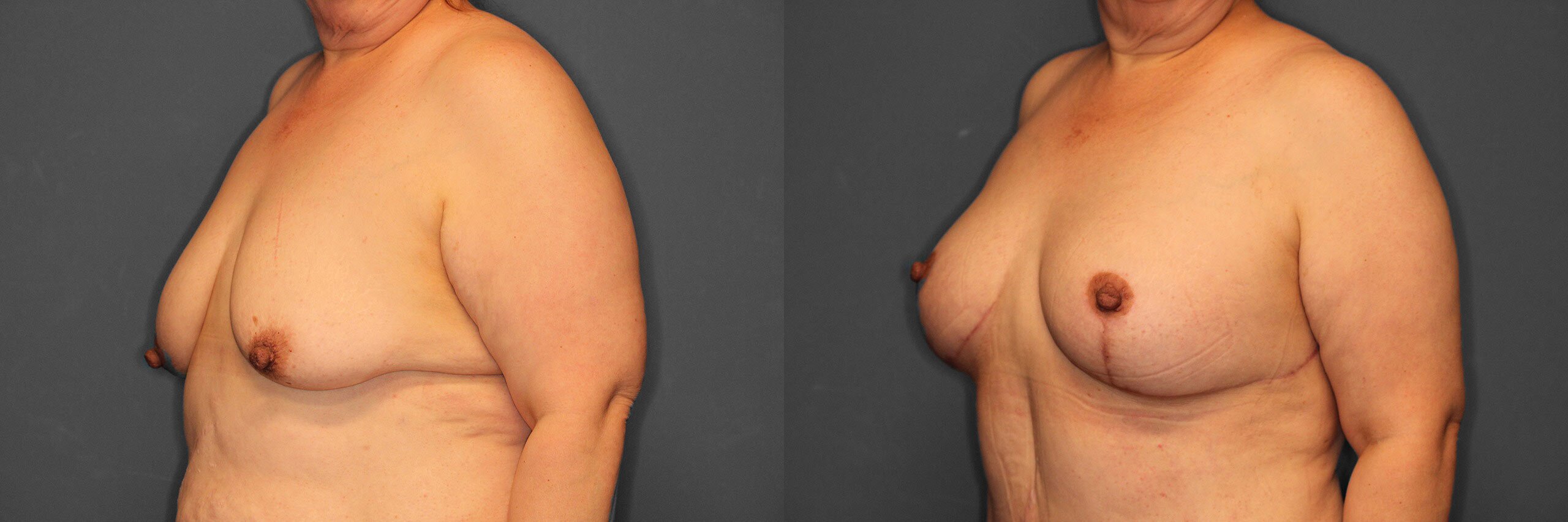 Breast Augmentation with Lift Before and After photo by Dr. Abigail Rodriguez in Houston, TX