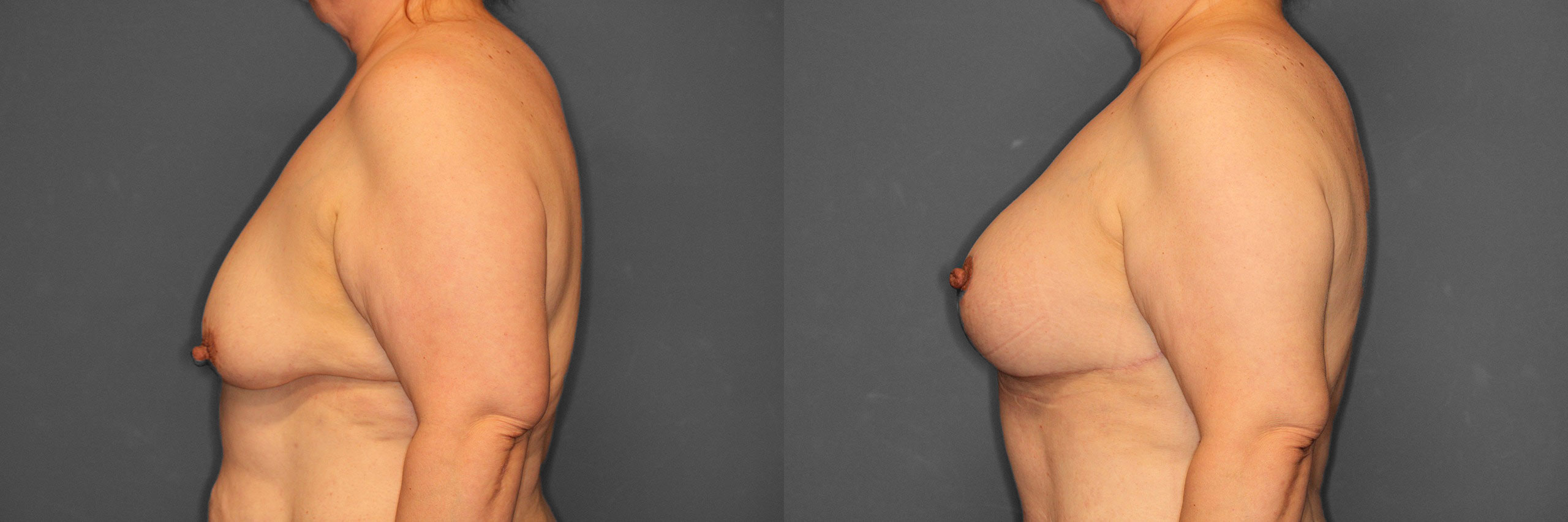 Breast Augmentation with Lift Before and After photo by Dr. Abigail Rodriguez in Houston, TX
