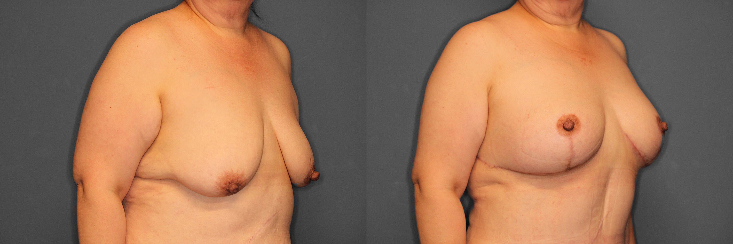 Breast Augmentation with Lift Before and After photo by Dr. Abigail Rodriguez in Houston, TX