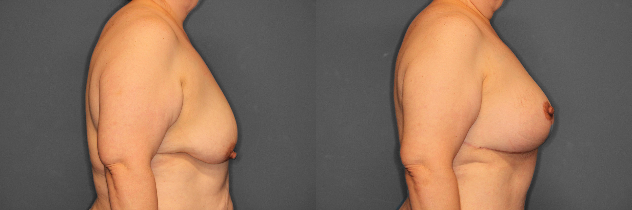 Breast Augmentation with Lift Before and After photo by Dr. Abigail Rodriguez in Houston, TX