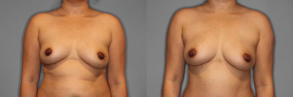 Breast Fat Grafting Before and After photo by Dr. Abigail Rodriguez in Houston, TX