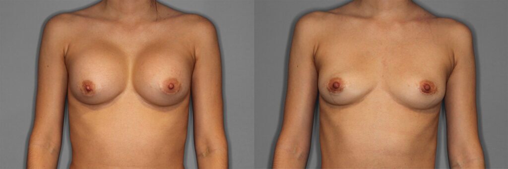 Breast Implant Removal Before and After photo by Dr. Abigail Rodriguez in Houston, TX