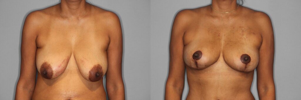 Breast Lift Before and After photo by Dr. Abigail Rodriguez in Houston, TX