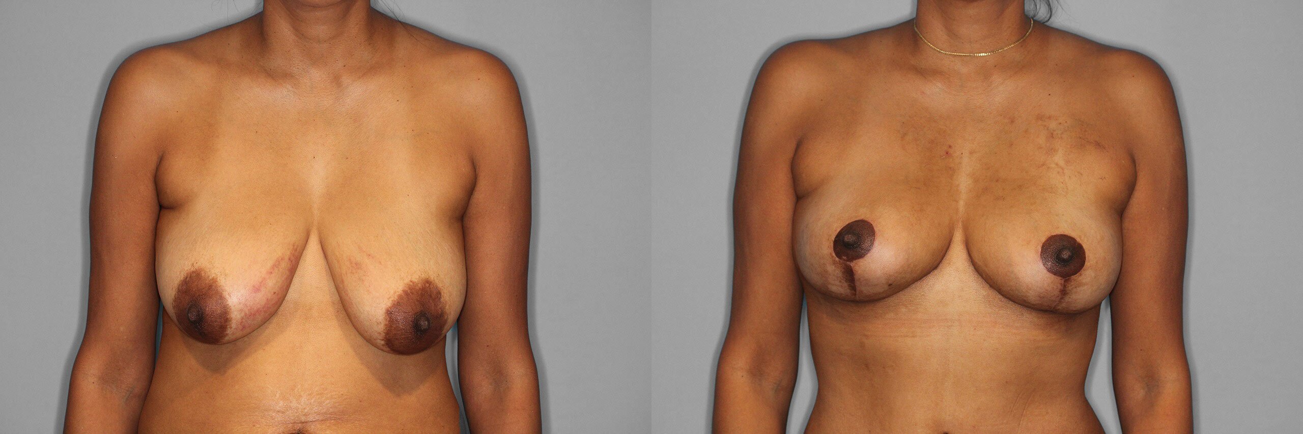 Breast Lift Before and After photo by Dr. Abigail Rodriguez in Houston, TX