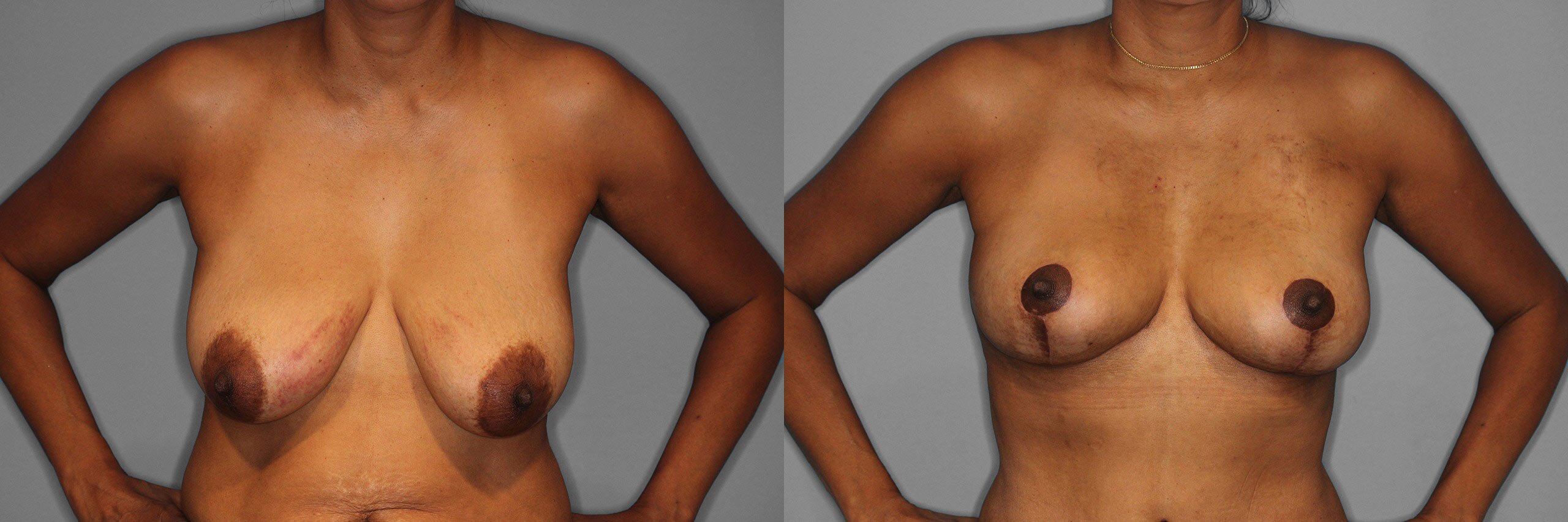Breast Lift Before and After photo by Dr. Abigail Rodriguez in Houston, TX
