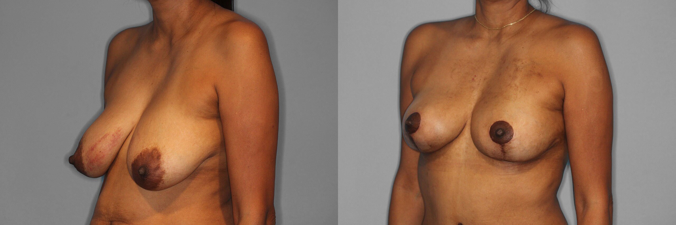Breast Lift Before and After photo by Dr. Abigail Rodriguez in Houston, TX