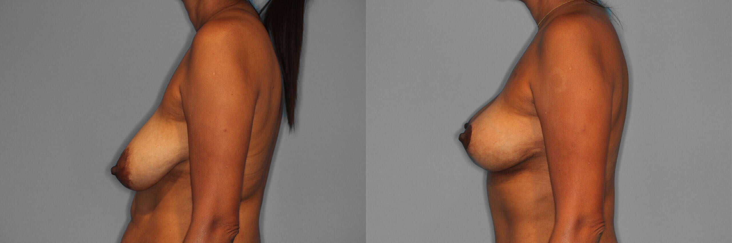 Breast Lift Before and After photo by Dr. Abigail Rodriguez in Houston, TX