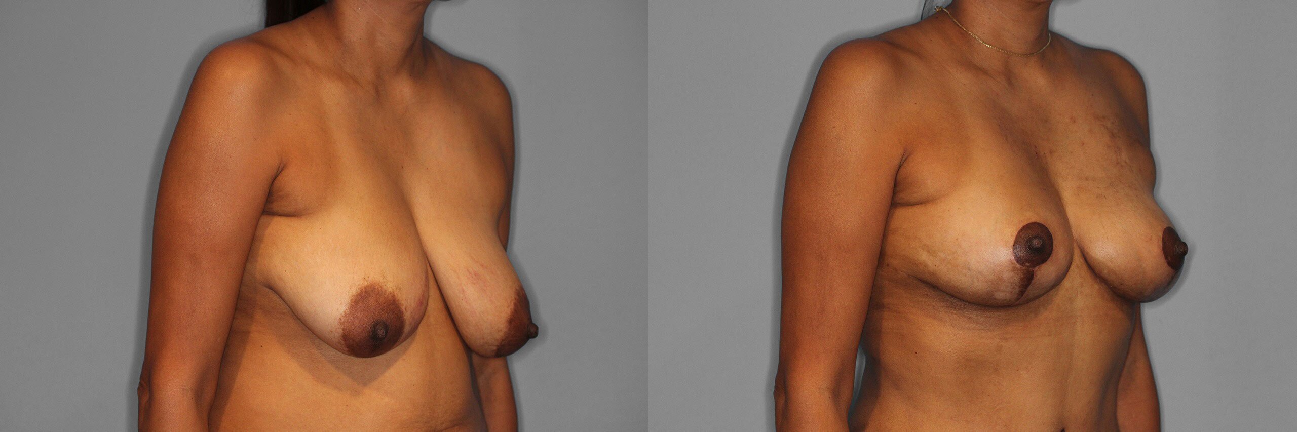 Breast Lift Before and After photo by Dr. Abigail Rodriguez in Houston, TX