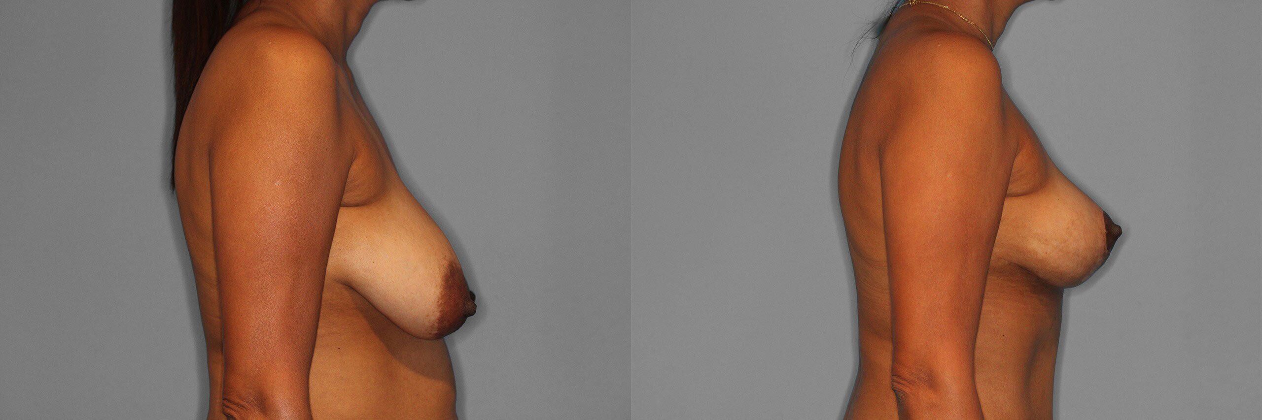 Breast Lift Before and After photo by Dr. Abigail Rodriguez in Houston, TX