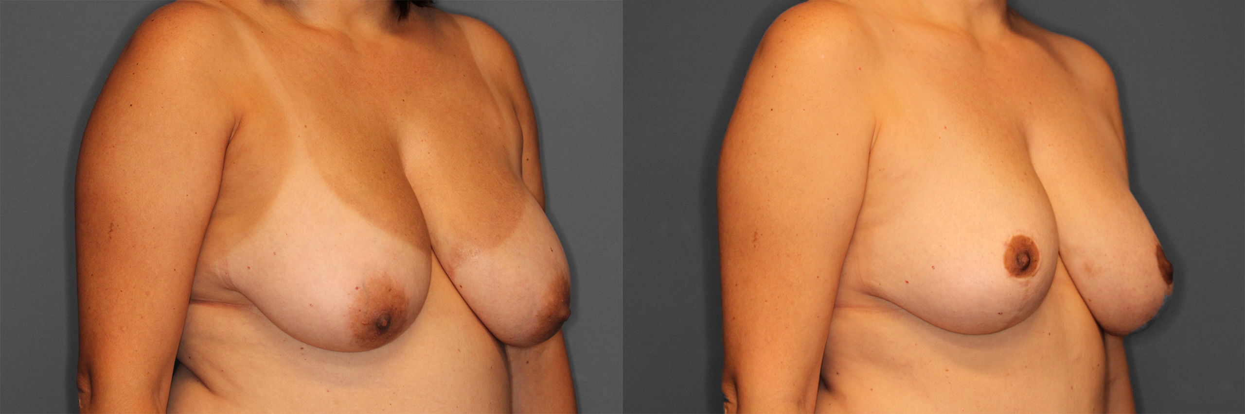 Breast Reduction Before and After photo by Dr. Abigail Rodriguez in Houston, TX