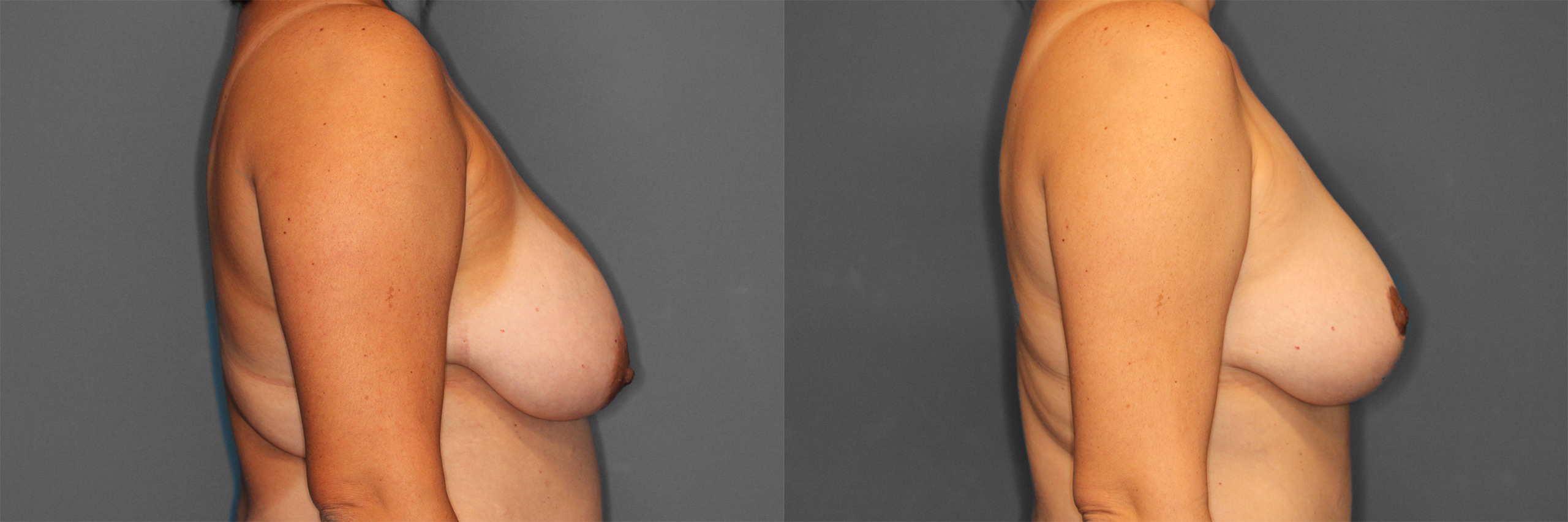 Breast Reduction Before and After photo by Dr. Abigail Rodriguez in Houston, TX