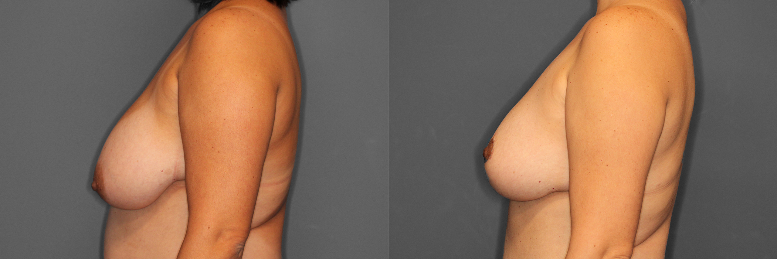 Breast Reduction Before and After photo by Dr. Abigail Rodriguez in Houston, TX