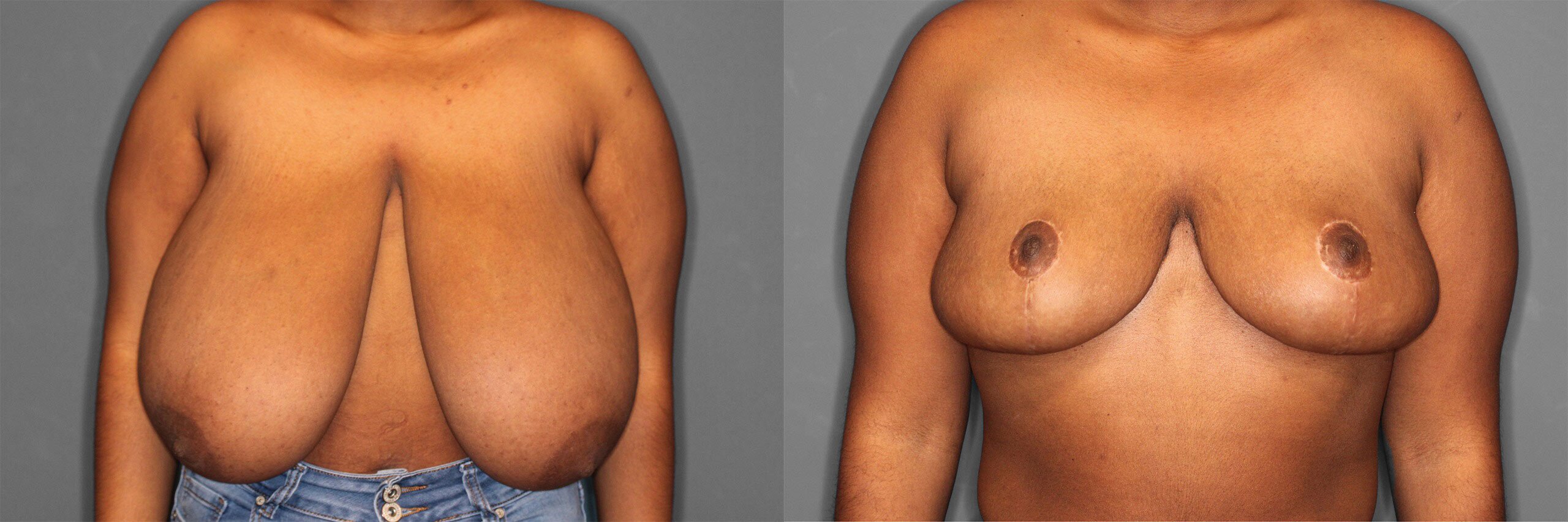 Breast Reduction Before and After photo by Dr. Abigail Rodriguez in Houston, TX