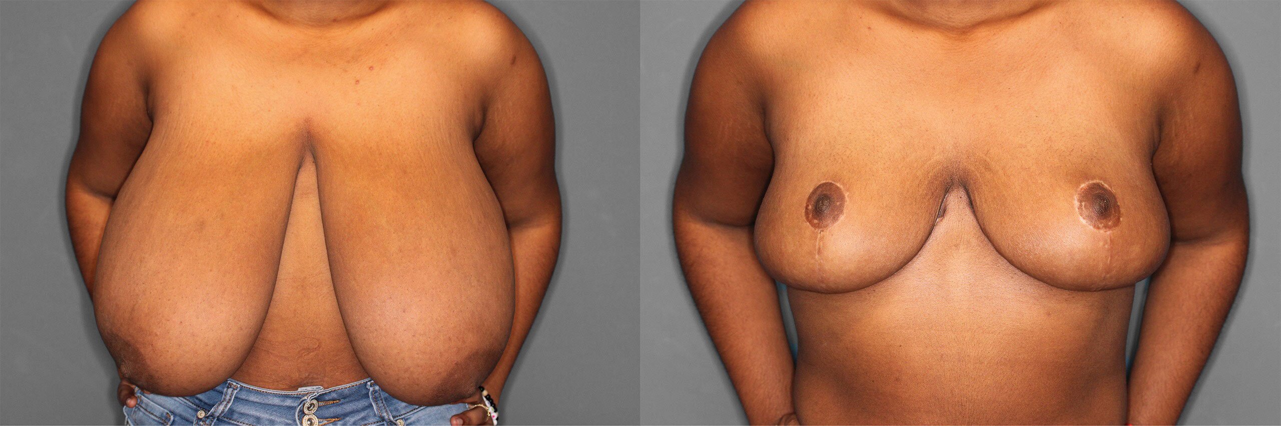 Breast Reduction Before and After photo by Dr. Abigail Rodriguez in Houston, TX