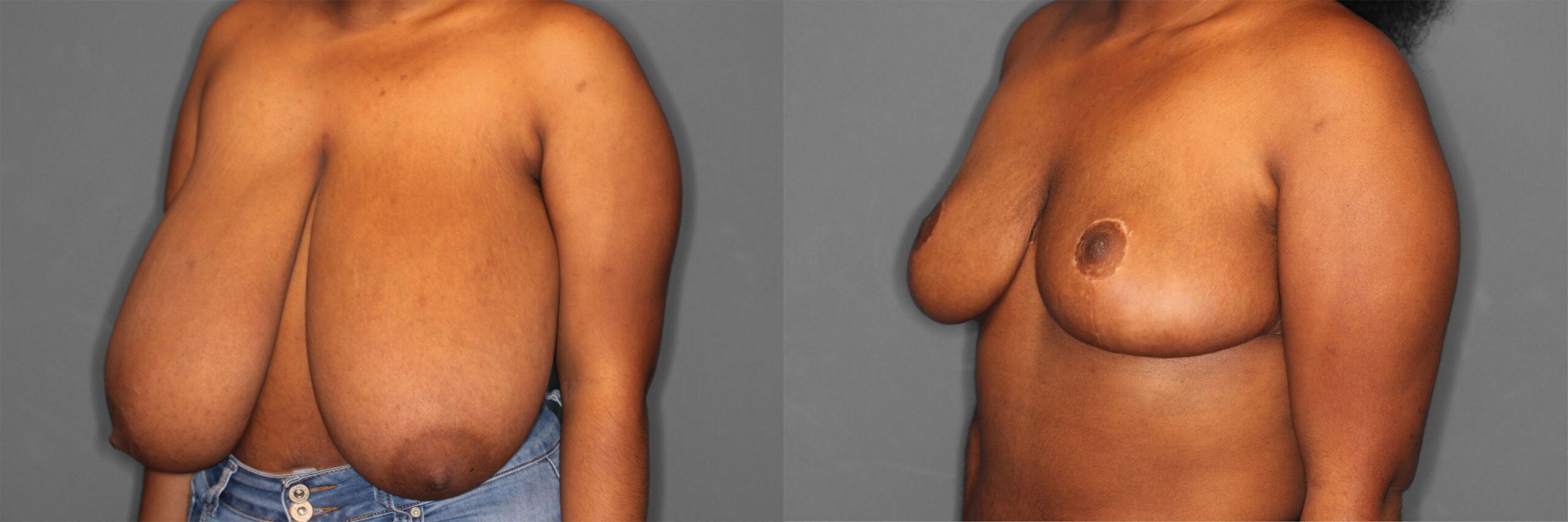 Breast Reduction Before and After photo by Dr. Abigail Rodriguez in Houston, TX