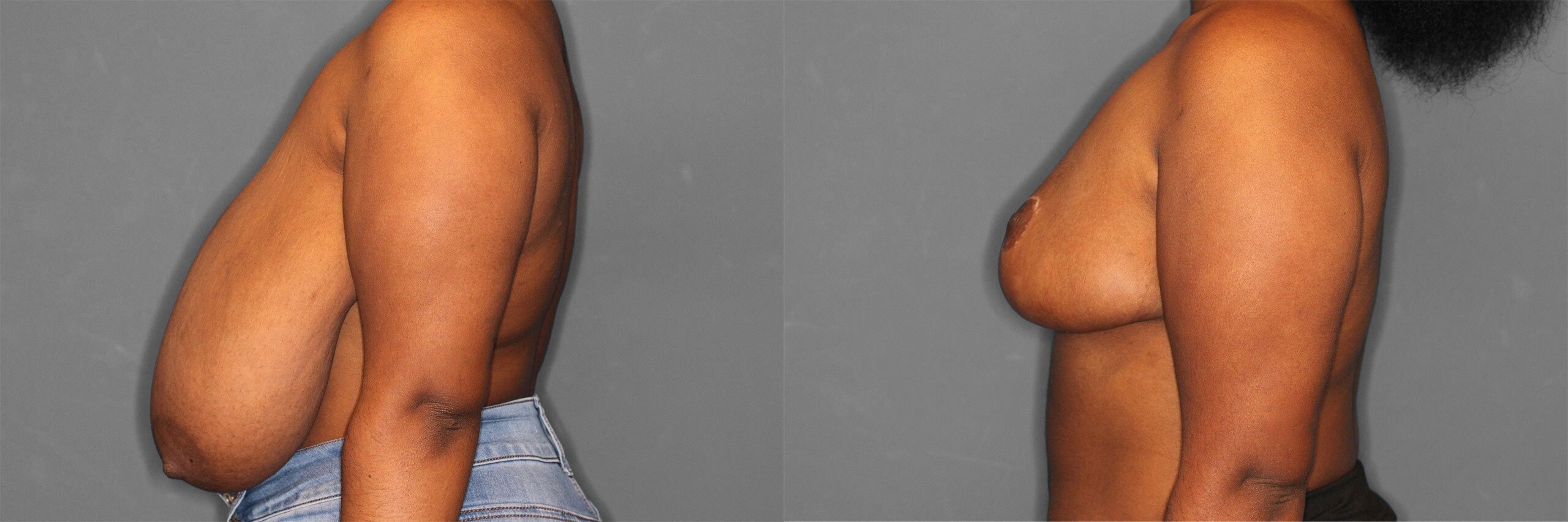 Breast Reduction Before and After photo by Dr. Abigail Rodriguez in Houston, TX