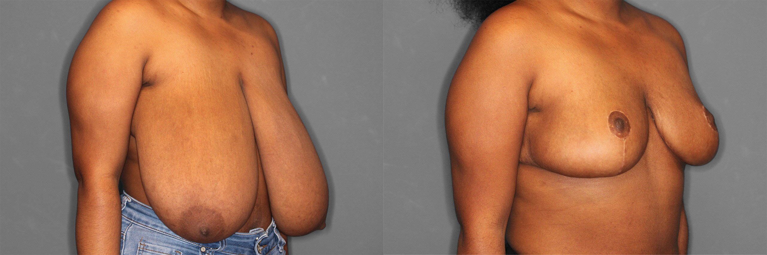 Breast Reduction Before and After photo by Dr. Abigail Rodriguez in Houston, TX