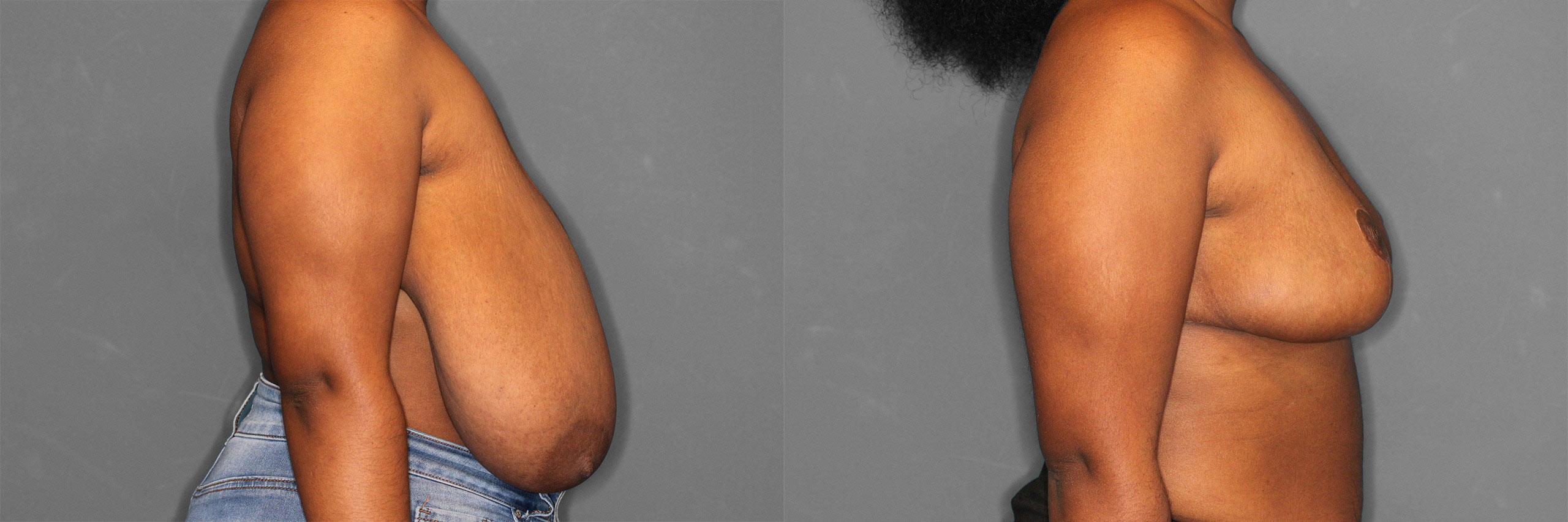 Breast Reduction Before and After photo by Dr. Abigail Rodriguez in Houston, TX