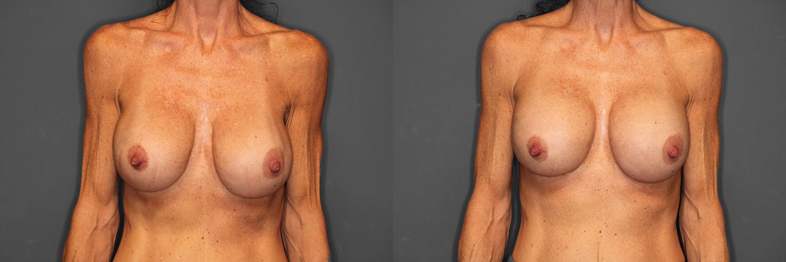 Breast Revision Before and After photo by Dr. Abigail Rodriguez in Houston, TX
