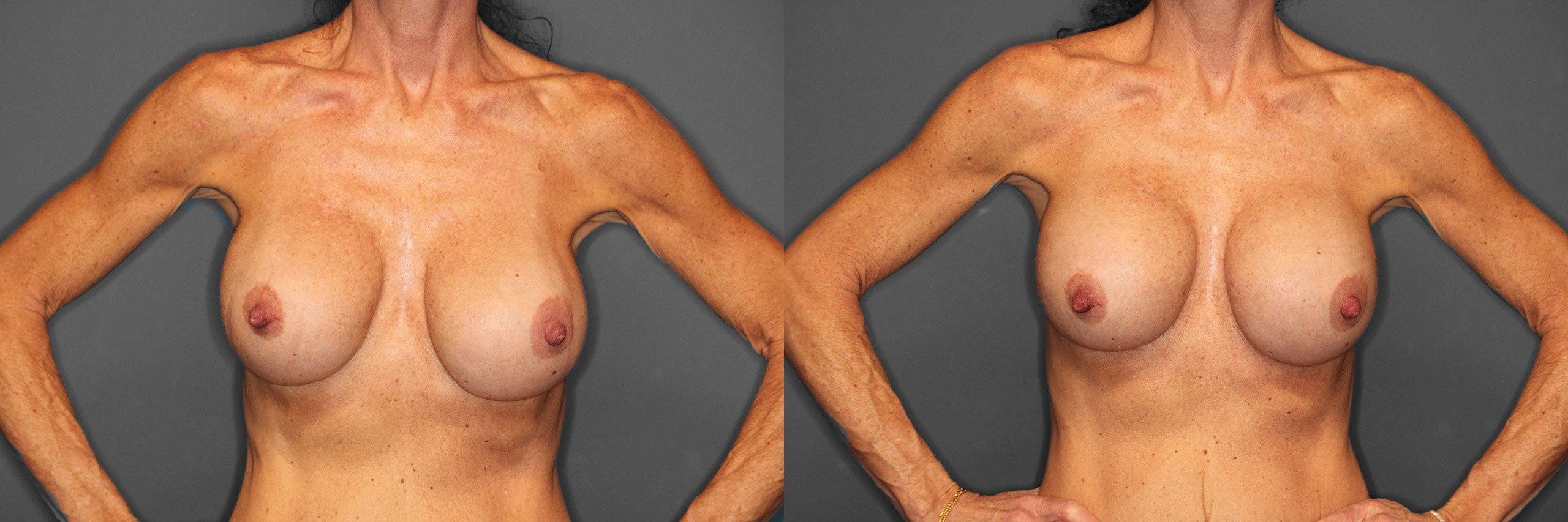 Breast Revision Before and After photo by Dr. Abigail Rodriguez in Houston, TX