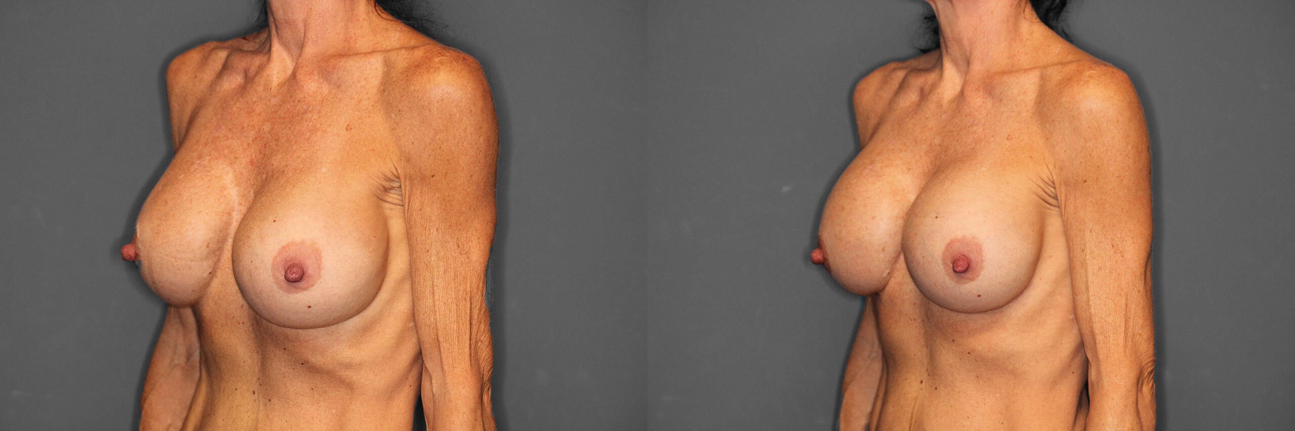 Breast Revision Before and After photo by Dr. Abigail Rodriguez in Houston, TX