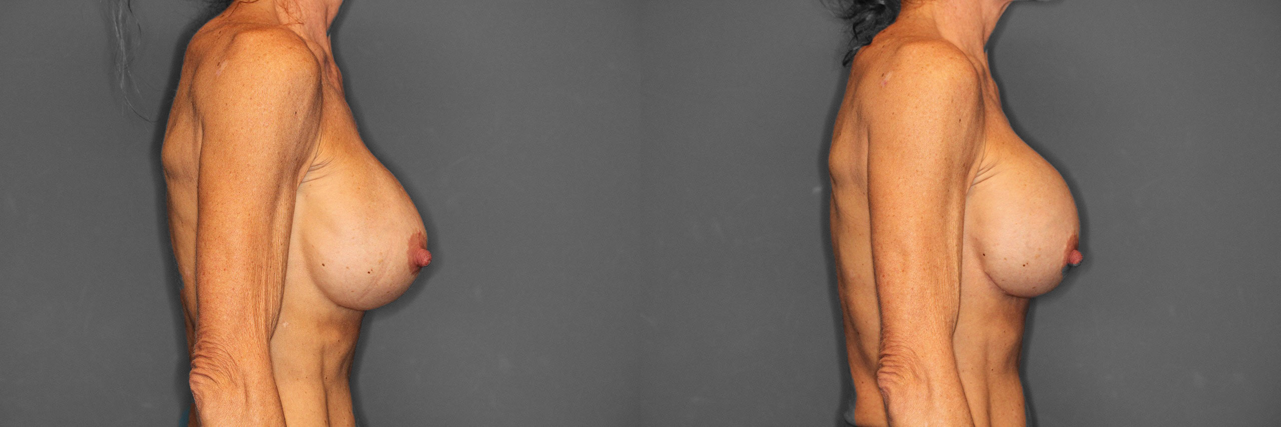 Breast Revision Before and After photo by Dr. Abigail Rodriguez in Houston, TX